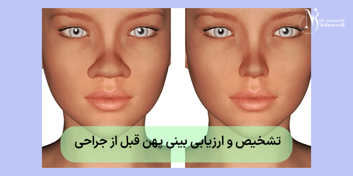 تشخیص و ارزیابی بینی پهن قبل از جراحی