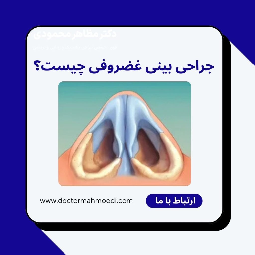 جراحی بینی غضروفی