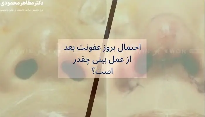 عفونت بعد از عمل بینی