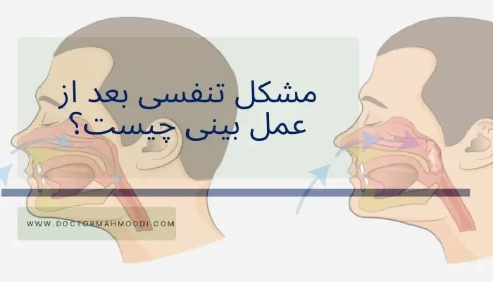 مشکل تنفسی بعد از عمل بینی