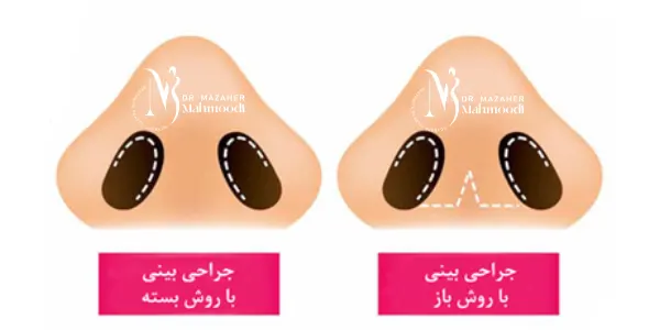 تفاوت جراحی باز و بسته