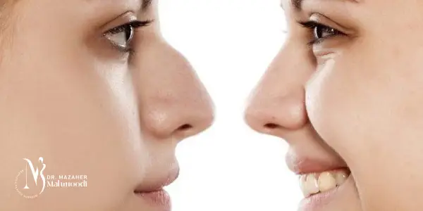 جراحی بینی ترمیم شده در کرج