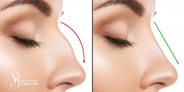 جراحی بینی ترمیم شده در کرج