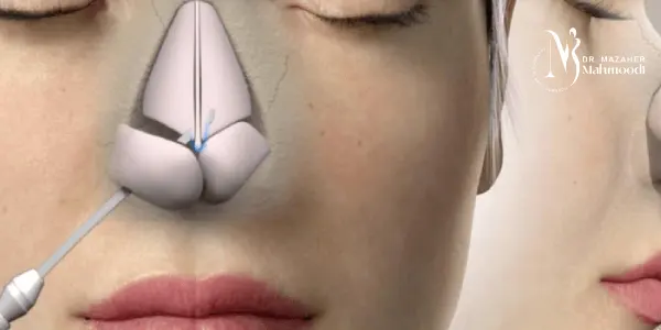 مزایا و معایب جراحی بینی بسته