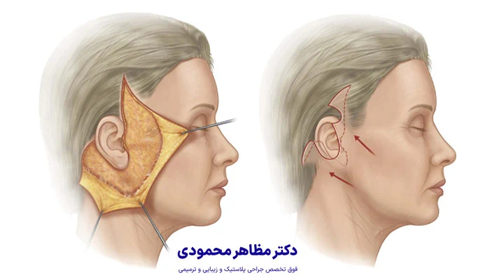 مراحل جراحی لیفت صورت