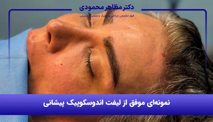 جراحی لیفت صورت آندوسکوپیک
