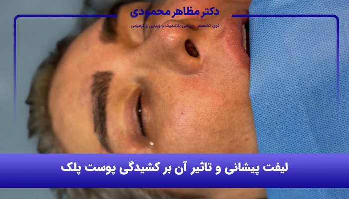 نتیجه جراحی لیفت صورت