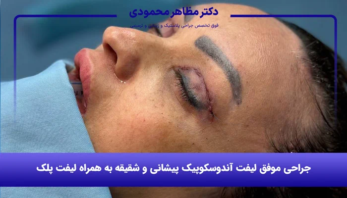 روش ترکیبی جراحی لیفت صورت