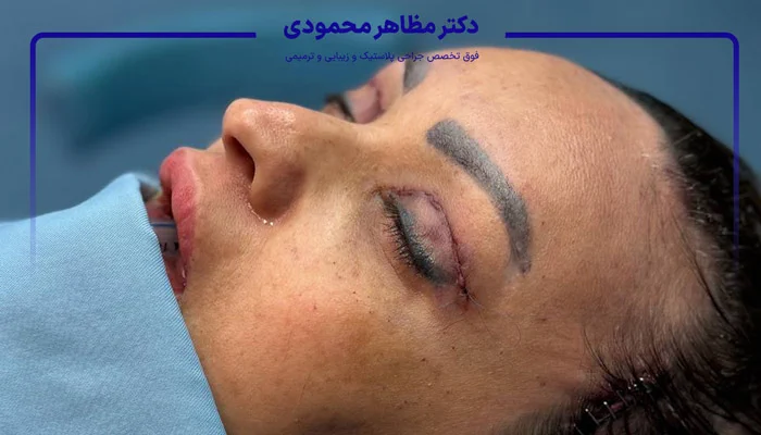 جراحی لیفت صورت