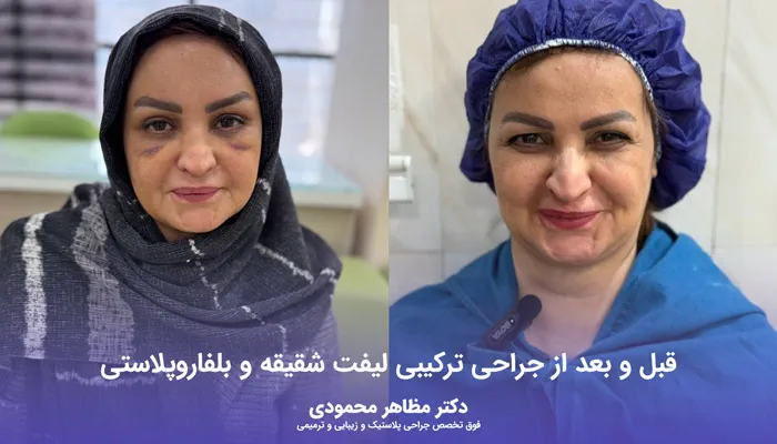 جراحی ترکیبی عمل لیفت شقیقه و بلفاروپلاستی