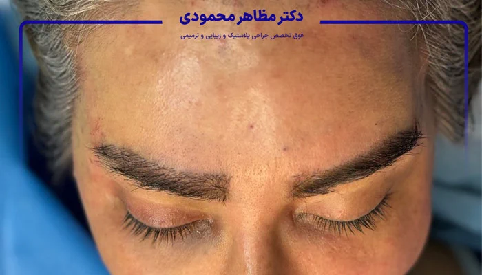 لیفت صورت و روش های کم تهاجمی آن