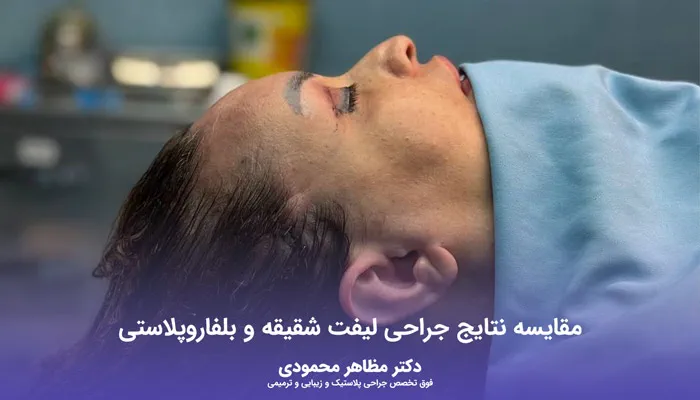 مقایسه نتیجه عمل لیفت شقیقه با بلفاروپلاستی