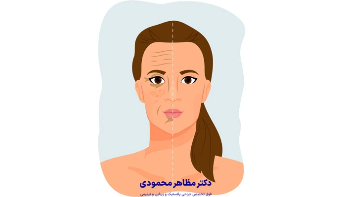 بوتاکس بهتر است یا لیفت صورت؟
