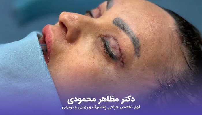 فرق عمل بلفاروپلاستی و لیفت شقیقه در دوره نقاهت