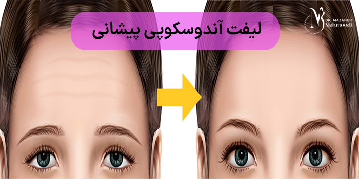 هزینه لیفت اندوسکوپیک پیشانی