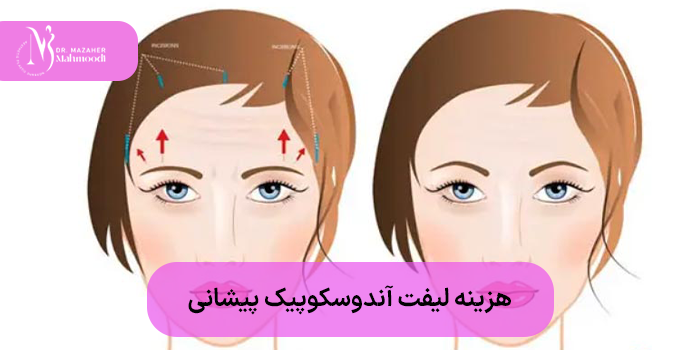 هزینه لیفت آندوسکوپیک پیشانی چقدر است؟
