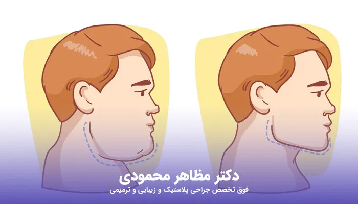 لیفت صورت برای مردان چگونه انجام میشود؟