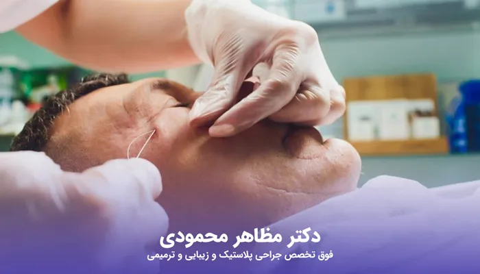 لیفت اندوسکوپیک صورت برای مردان