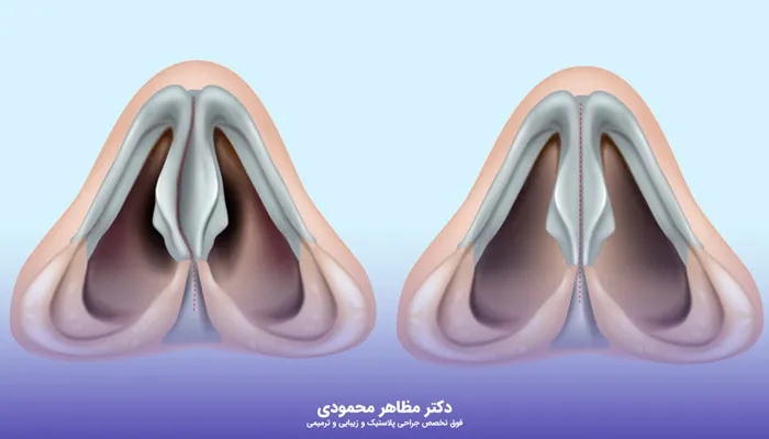عمل انحراف بینی چه مزایایی دارد؟