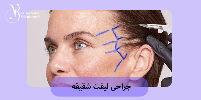 جراحی لیفت شقیقه در کرج